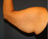 Feel Beautiful - Arm Reduction 209 - Before Photo